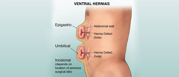 Hernia Specialist in Chennai